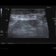Acute appendicitis: US - Ultrasound