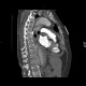 Aortic dissection, Stanford A, hemopericard: CT - Computed tomography