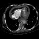 Aortic dissection, Stanford A, hemopericard: CT - Computed tomography