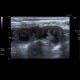 Acute enteritis, enteritis, edema of the valvulae conniventes: US - Ultrasound