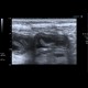 Acute enteritis, enteritis, edema of the valvulae conniventes: US - Ultrasound