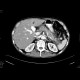 Chronic pancreatitis - acute exacerbation: CT - Computed tomography