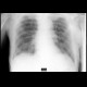 Chronic bronchitis, acute exacerbation: X-ray - Plain radiograph
