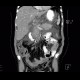 Acute pancreatitis, chylous pancreatitis, hypertriglyceridemia-associated acute pancreatitis: CT - Computed tomography