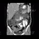 Acute pancreatitis, chylous pancreatitis, hypertriglyceridemia-associated acute pancreatitis: CT - Computed tomography