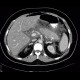 Acute pancreatitis, chylous pancreatitis, hypertriglyceridemia-associated acute pancreatitis: CT - Computed tomography