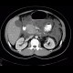 Acute pancreatitis, chylous pancreatitis, hypertriglyceridemia-associated acute pancreatitis: CT - Computed tomography