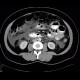 Acute pancreatitis, chylous pancreatitis, hypertriglyceridemia-associated acute pancreatitis: CT - Computed tomography