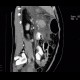 Acute pancreatitis, chylous pancreatitis, hypertriglyceridemia-associated acute pancreatitis: CT - Computed tomography