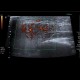 Acute parotitis: US - Ultrasound