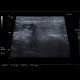 Acute parotitis: US - Ultrasound
