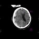 Acute subdural hemorrhage, active bleeding: CT - Computed tomography