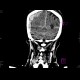 Acute subdural hemorrhage, active bleeding, subfalcine herniation: CT - Computed tomography