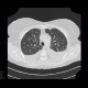 Pulmonary amyloidosis, diffuse parenchymal form: CT - Computed tomography