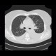 Pulmonary amyloidosis, diffuse parenchymal form: CT - Computed tomography