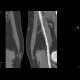 Distal anastomosis of femoro-popliteal bypass: CT - Computed tomography