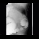 Anastomosis of large bowel on barium enema: RF - Fluoroscopy