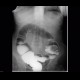 Anastomosis of large bowel on barium enema: RF - Fluoroscopy