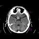 Aneurysm of the internal carotid artery - non-enhanced: CT - Computed tomography