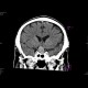 Aneurysm of the internal carotid artery - non-enhanced: CT - Computed tomography