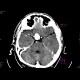 Aneurysm of the internal carotid artery - contrast enhanced: CT - Computed tomography