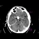 Aneurysm of the internal carotid artery - contrast enhanced: CT - Computed tomography