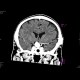 Aneurysm of the internal carotid artery - contrast enhanced: CT - Computed tomography