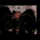 Aneurysm of the internal carotid artery - VRT: CT - Computed tomography