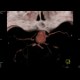 Aneurysm of the internal carotid artery - VRT: CT - Computed tomography