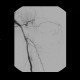 Angiography of lipoma, arm, thoracoacromial artery, preoperative, DSA: AG - Angiography