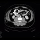 Angiolipoma, subcutaneous, selective embolisation: CT - Computed tomography