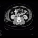 Angiolipoma, subcutaneous, selective embolisation: CT - Computed tomography