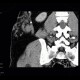 Angiolipoma, subcutaneous, selective embolisation: CT - Computed tomography