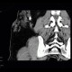 Angiolipoma, subcutaneous, selective embolisation: CT - Computed tomography