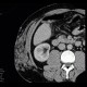 Angiolipoma, subcutaneous, selective embolisation: CT - Computed tomography