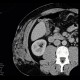 Angiolipoma, subcutaneous, selective embolisation: CT - Computed tomography