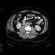 Angiolipoma, subcutaneous, selective embolisation: CT - Computed tomography
