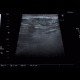 Angiolipoma, subcutaneous, selective embolisation: US - Ultrasound