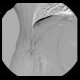 Angiolipoma, subcutaneous, selective embolisation: AG - Angiography