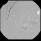 Angiolipoma, subcutaneous, selective embolisation: AG - Angiography