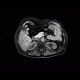 Angiomyolipoma of kidney, atypical: MRI - Magnetic Resonance Imaging