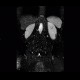 Angiomyolipoma of kidney, atypical: MRI - Magnetic Resonance Imaging