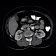 Angiomyolipoma of kidney, atypical: CT - Computed tomography