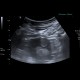 Angiomyolipoma of kidney, atypical: US - Ultrasound
