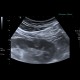 Angiomyolipoma of kidney, atypical: US - Ultrasound