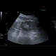 Angiomyolipoma of kidney, atypical: US - Ultrasound
