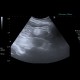 Angiomyolipoma of kidney, renal angiomyolipoma: US - Ultrasound