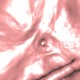 Appendiceal orifice: CT - Computed tomography