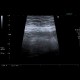 Acute appendicitis: US - Ultrasound