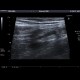 Acute appendicitis: US - Ultrasound